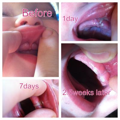 Before/after photos of baby