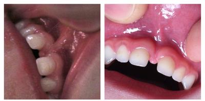 before/2.5 weeks after photo of 2 year old